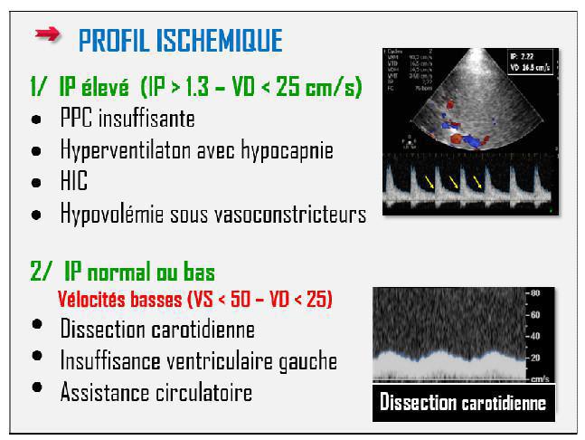 DTC (Doppler Transcranien)