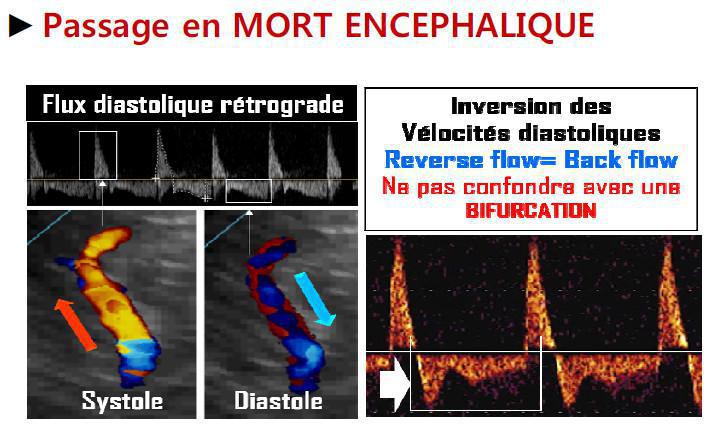 DTC (Doppler Transcranien)