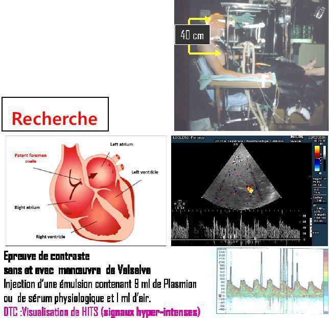 DTC (Doppler Transcranien)