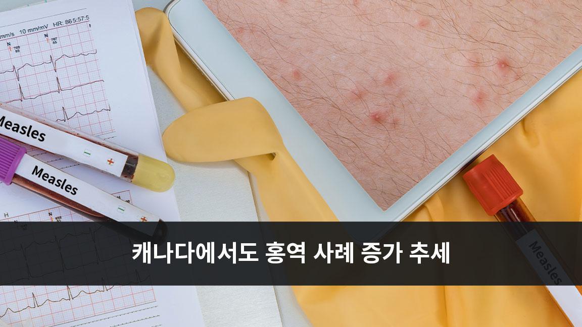 캐나다에서도 홍역 사례 증가 추세 캐나다에서도 홍역 사례 증가 추세