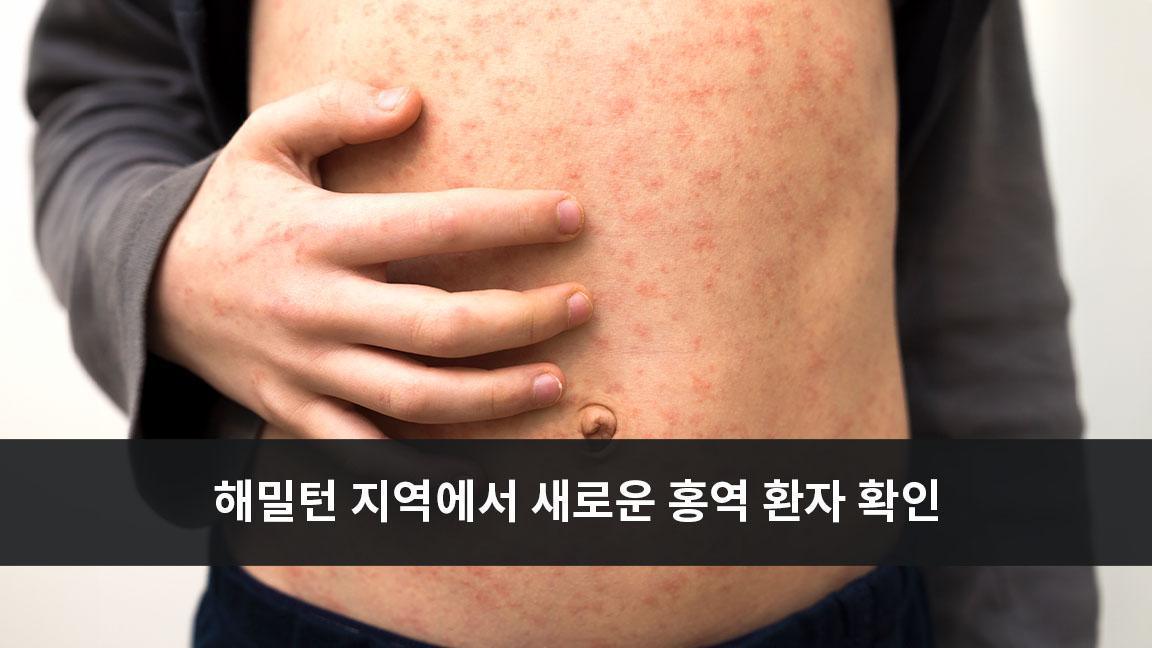 해밀턴 지역에서 새로운 홍역 환자 확인 해밀턴 지역에서 새로운 홍역 환자 확인