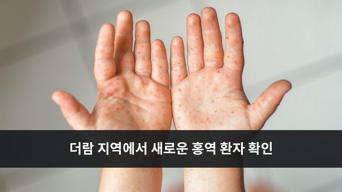 더람 지역에서 새로운 홍역 환자 확인