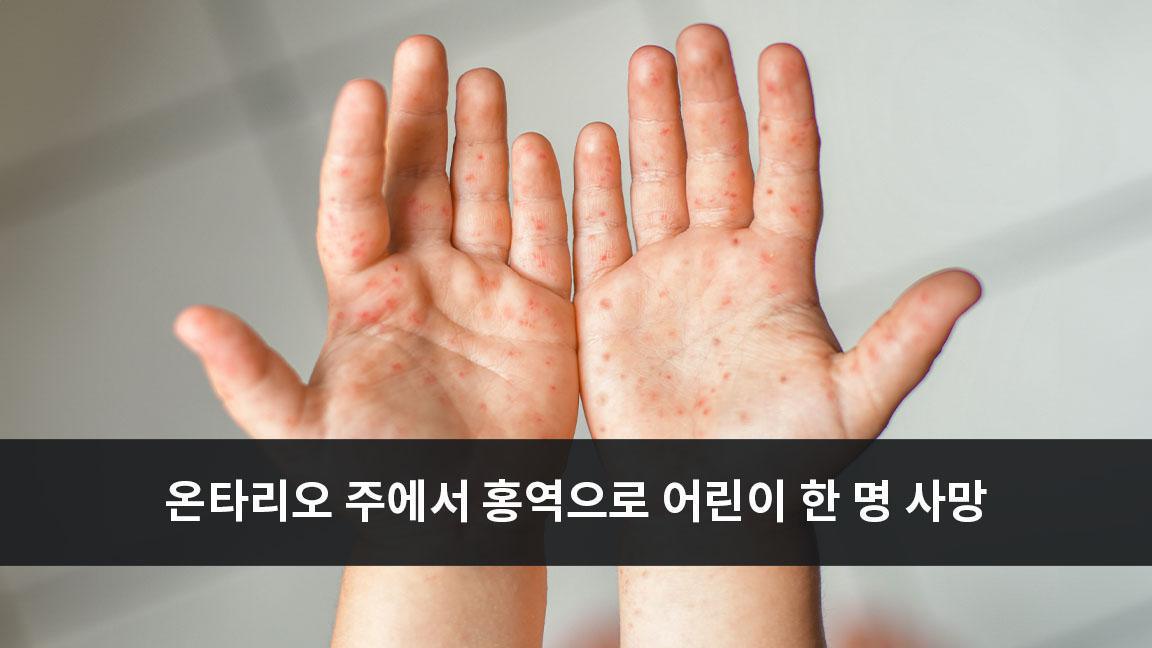 온타리오 주에서 홍역으로 어린이 한 명 사망 온타리오 주에서 홍역으로 어린이 한 명 사망