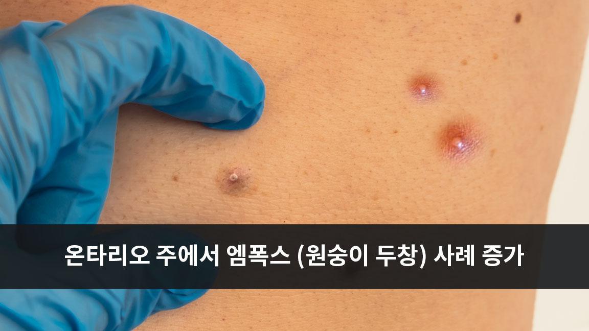 온타리오 주에서 엠폭스 (원숭이 두창) 사례 증가 온타리오 주에서 엠폭스 (원숭이 두창) 사례 증가