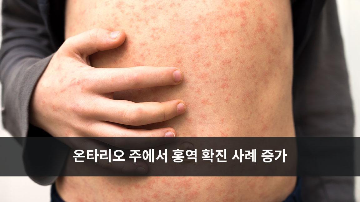 온타리오 주에서 홍역 확진 사례 증가 온타리오 주에서 홍역 확진 사례 증가