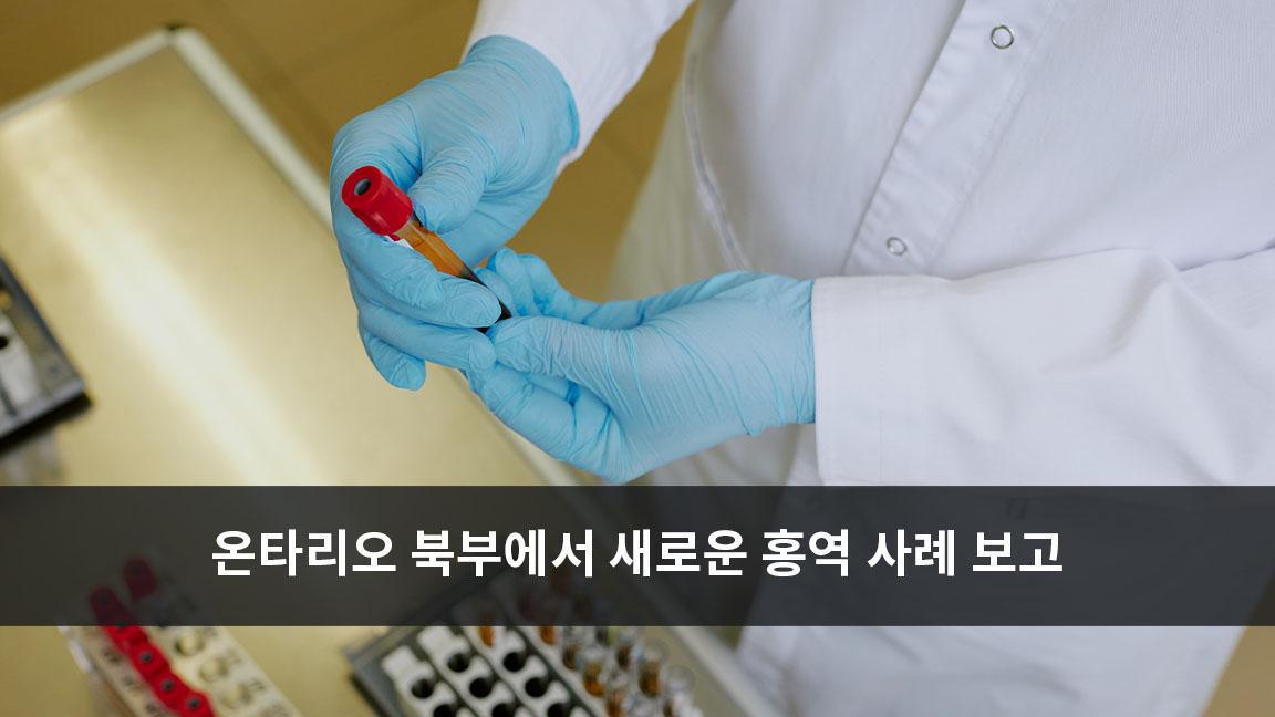 온타리오 북부에서 새로운 홍역 사례 보고 온타리오 북부에서 새로운 홍역 사례 보고