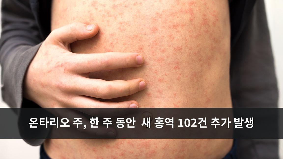 온타리오 주, 한 주 동안 새로운 홍역 사례 102건 추가 발생 온타리오 주, 한 주 동안 새로운 홍역 사례 102건 추가 발생