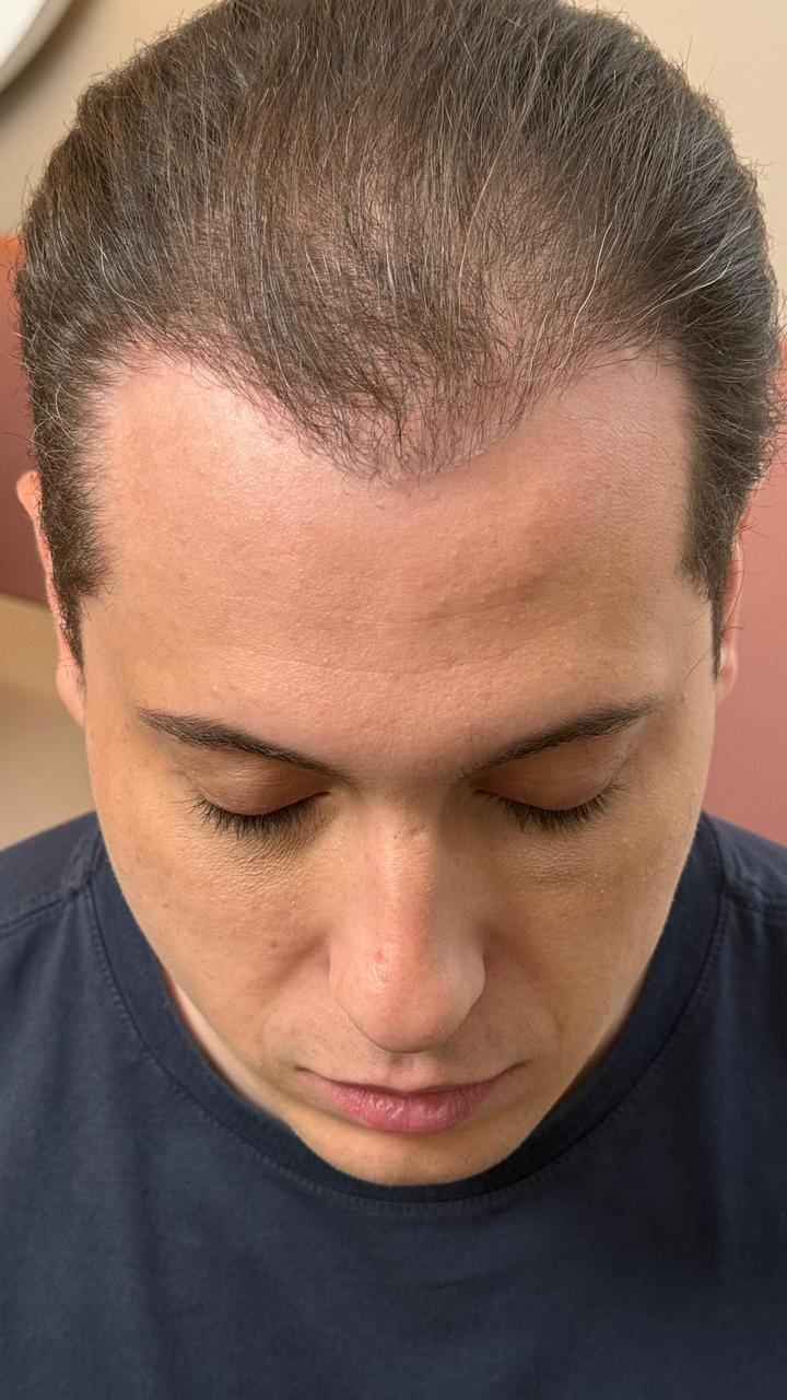 Ilusionista Klauss, da dupla com Henry, viaja mais de 1000 km para realizar transplante capilar com a médica nº1 do mundo