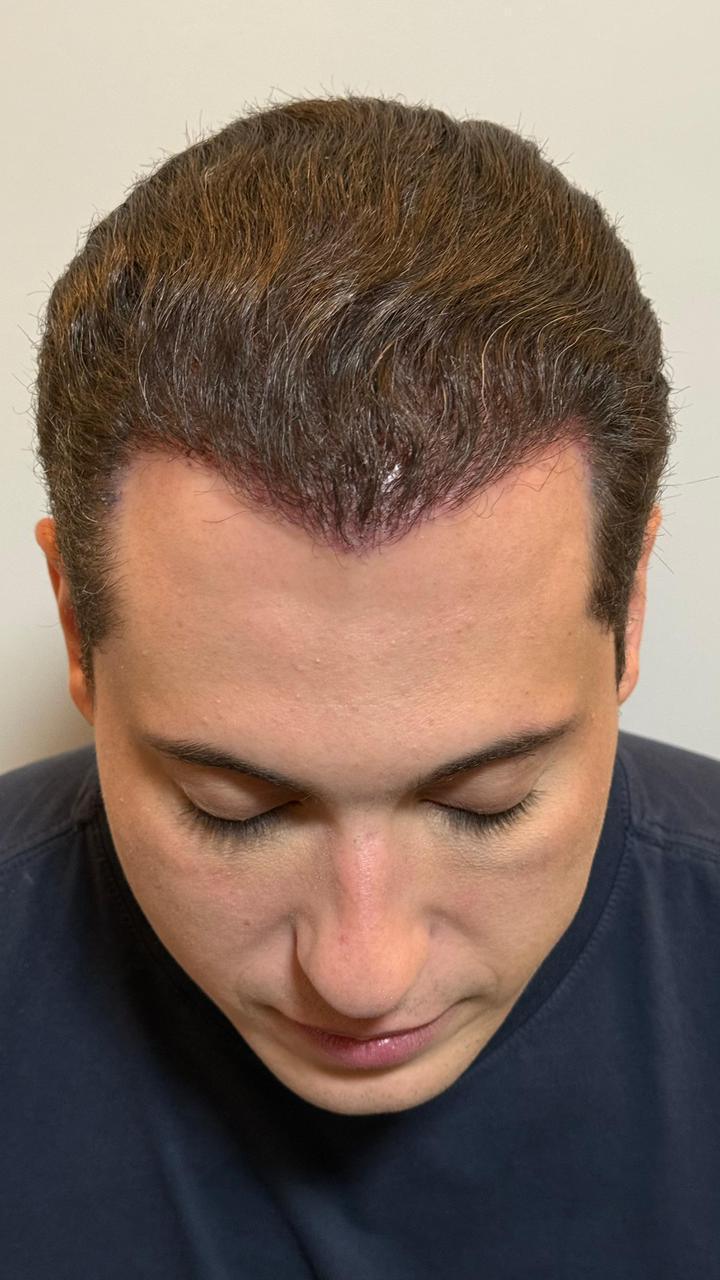 Ilusionista Klauss, da dupla com Henry, viaja mais de 1000 km para realizar transplante capilar com a médica nº1 do mundo