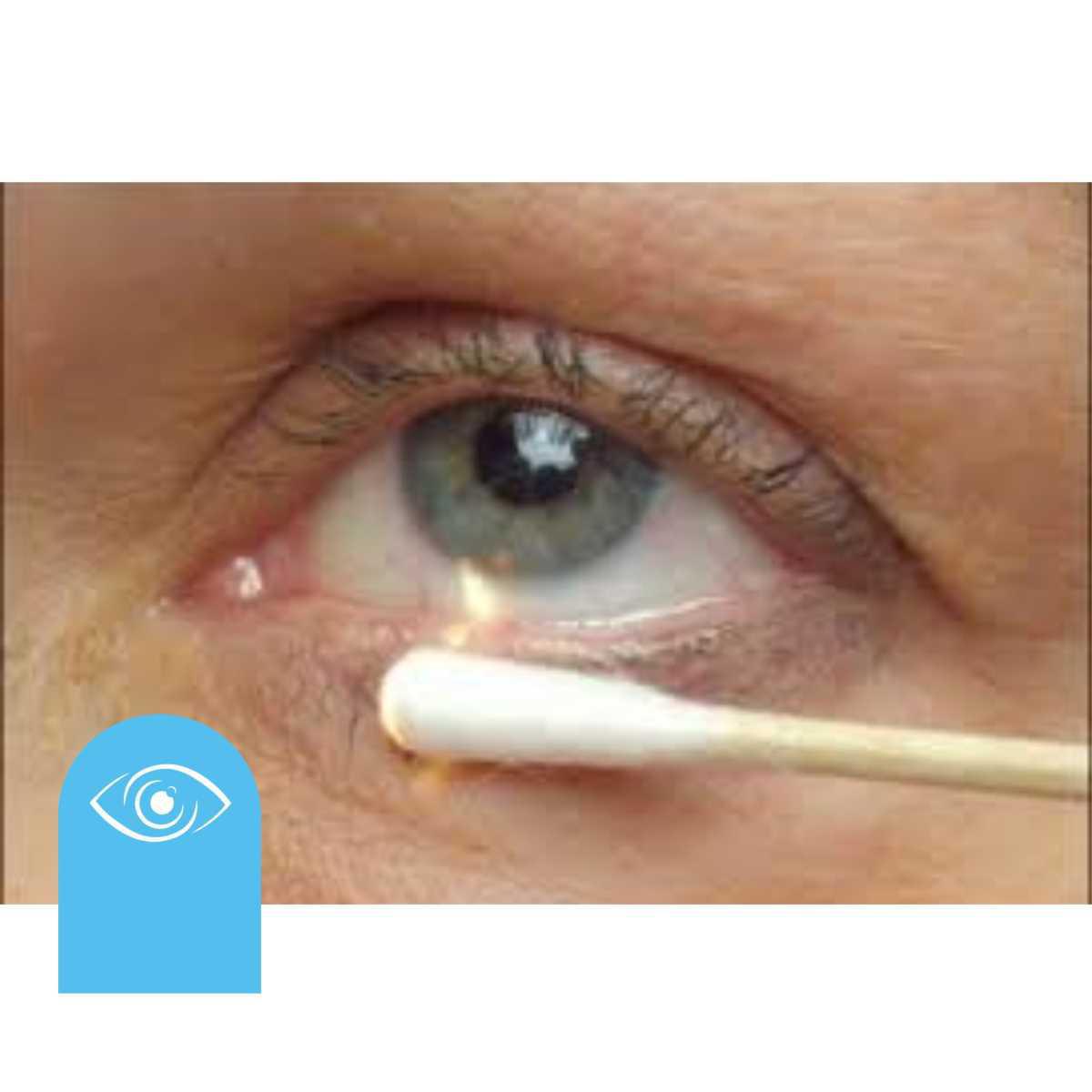 Categorías de ojo seco Categorías de ojo seco