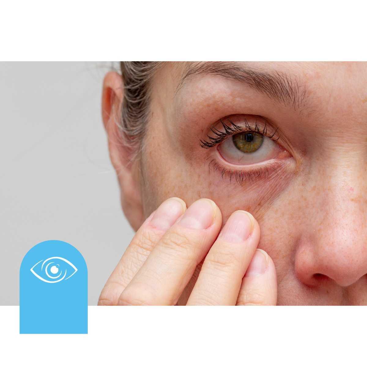 ¿Que es el ojo Seco?