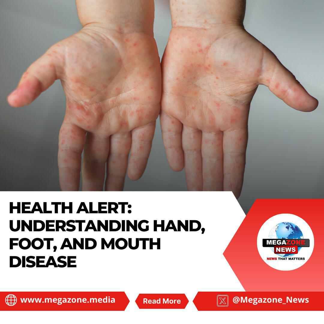 Health Alert: Understanding Hand, Foot, and Mouth Disease