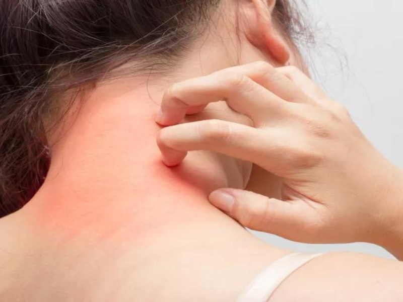 كيف تؤثر الأطعمة على حساسية الهيستامين وتسبب الحكة؟