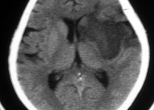 Accident vasculaire cérébral ischémique