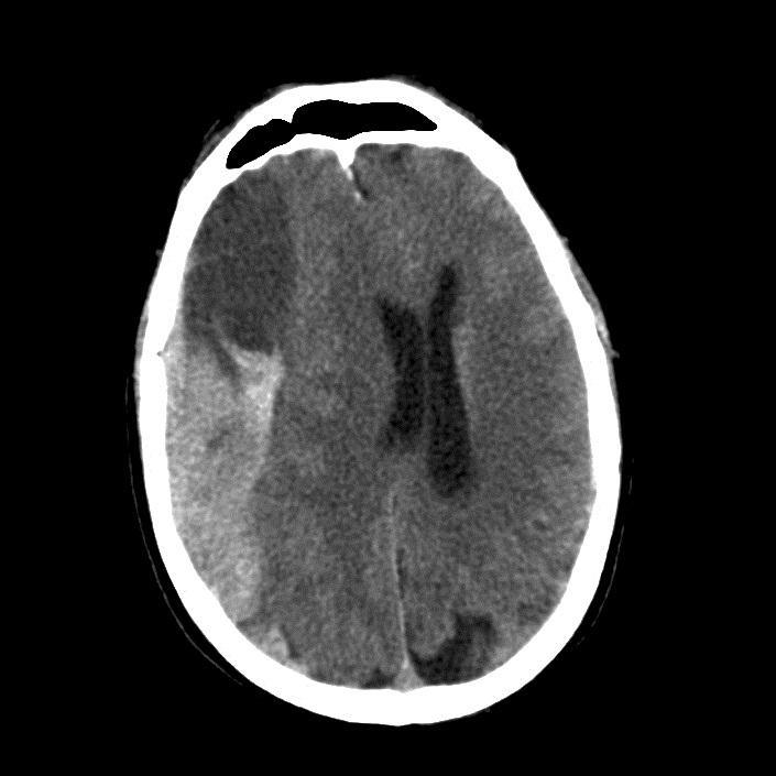 Acute on Chronic SDH