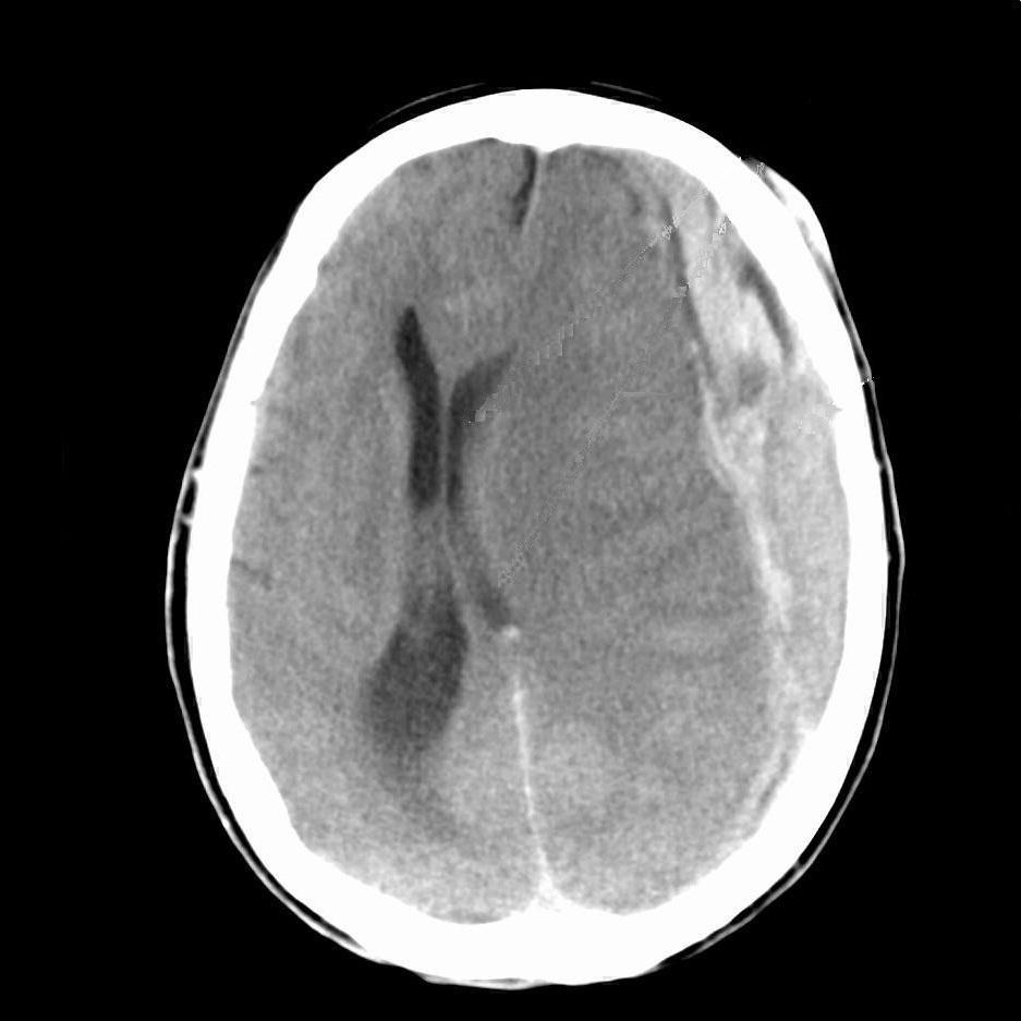 Acute Subdural