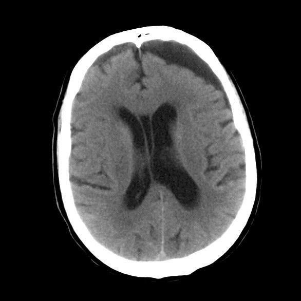 Chronic Subdural Haemorrhage