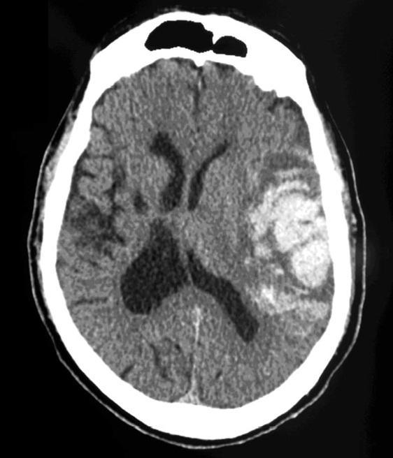 Intracerebral Haem
