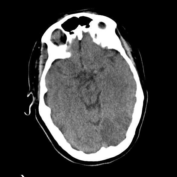 PCA Infarct