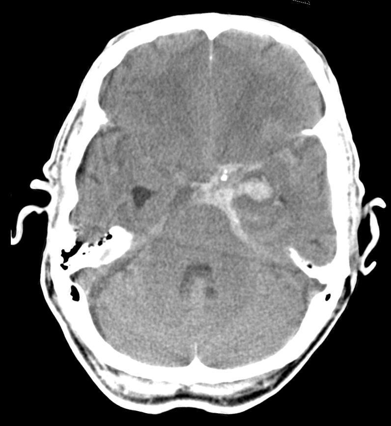 Subarachnoid Haem