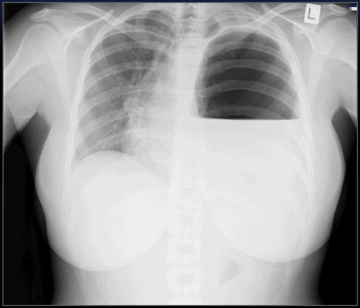 Diaphragm Rupture CXR