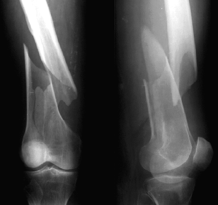 Low Femoral Fracture