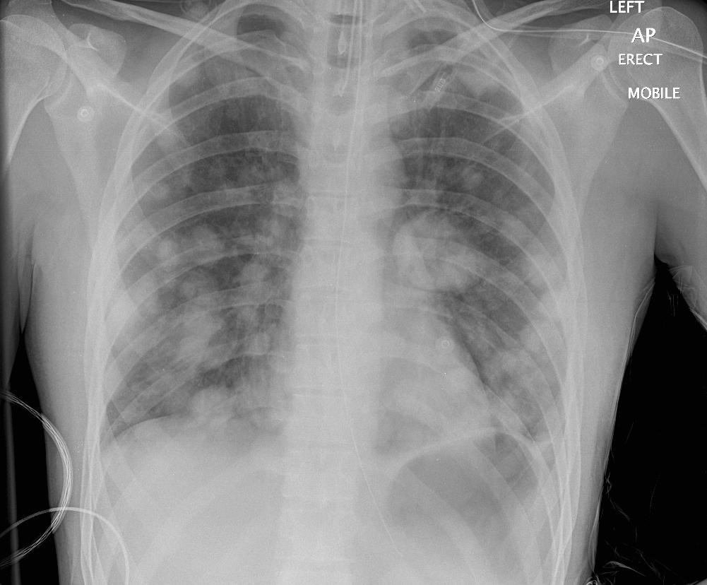 Lung Mets CXR
