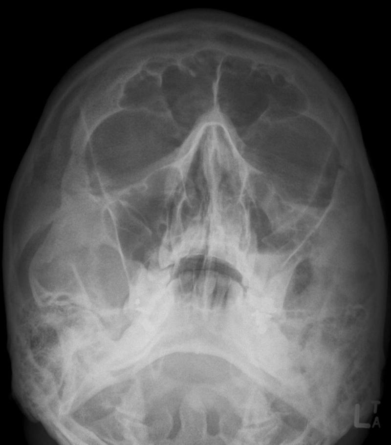 Orbital Floor Fracture