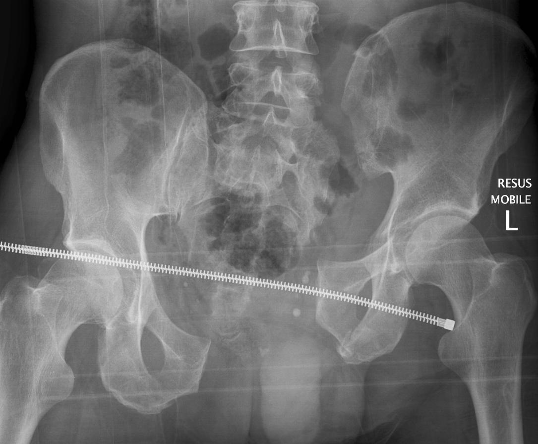 Pelvis Severe Trauma