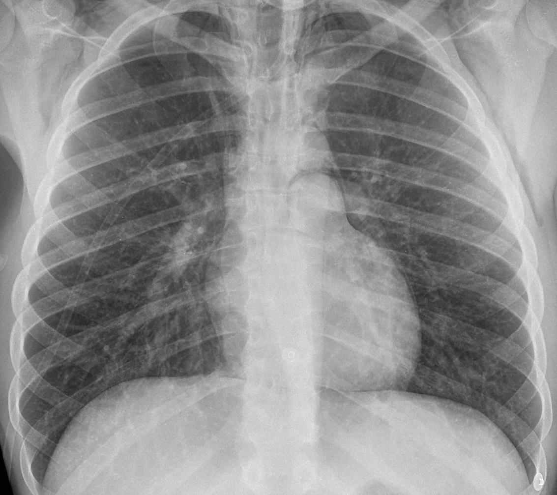 Pneumomediastinum Surgical Emphysema
