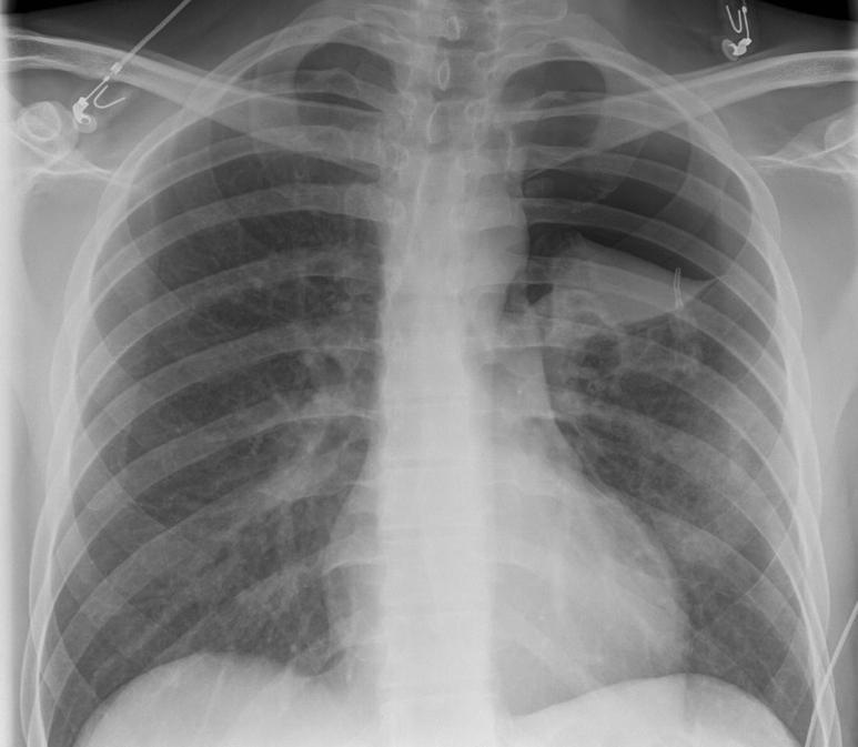 Pneumothorax with Cannula