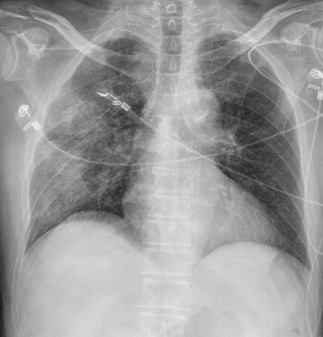 Rib Fractures Supine Haemothorax