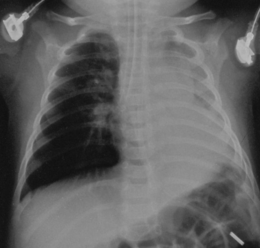 RMB Intubation, Left Collapse