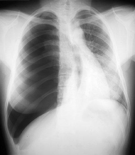 Tension Pneumothorax