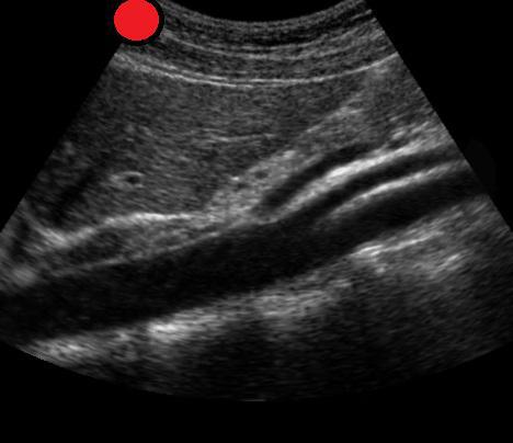Abdominal Aorta Longitudinal
