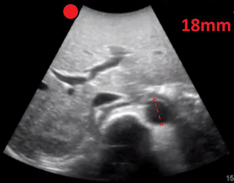 Abdominal Aorta Proximal Transverse