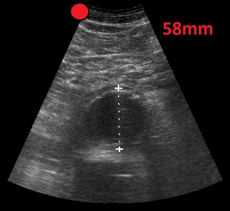 Abdominal Aortic Aneurysm Transverse