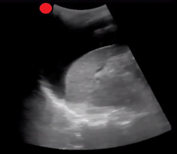 LUQ with Free Fluid 2