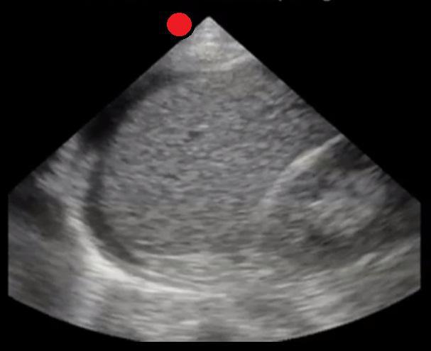 LUQ with free fluid 3