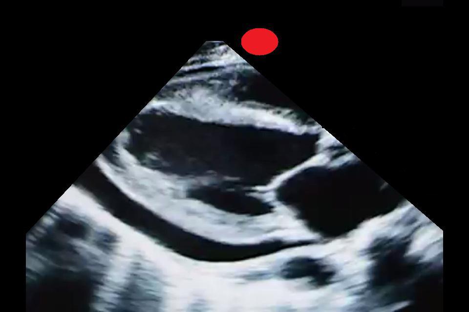 Pericardial Effusion