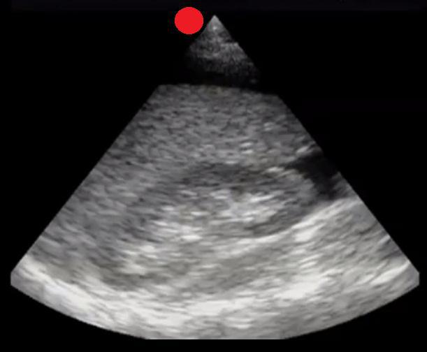 RUQ with Free Fluid 2