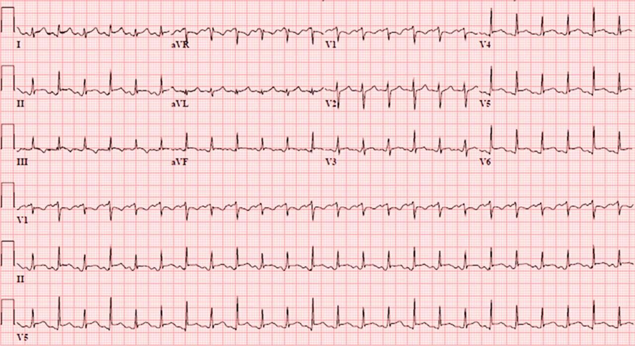 Electrical Alternans