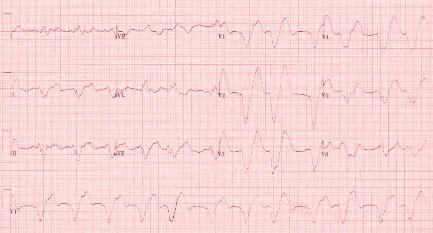 Hyperkalaemia - Severe