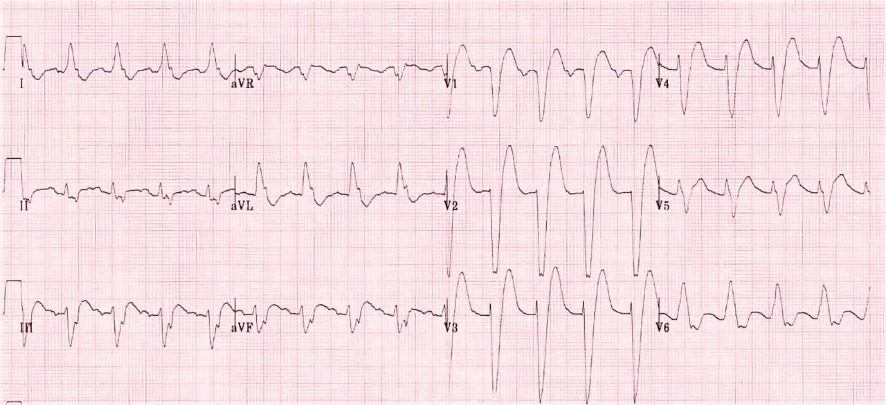 Left Bundle Branch Block