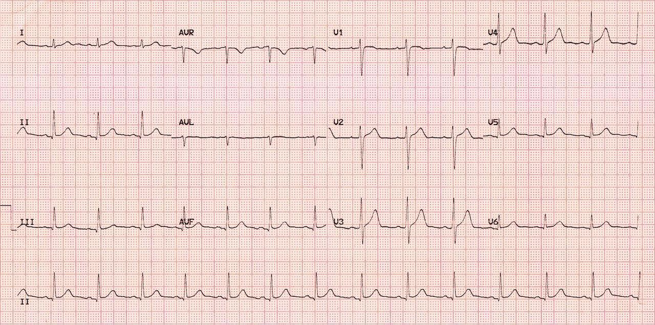 Normal Sinus Rhythm