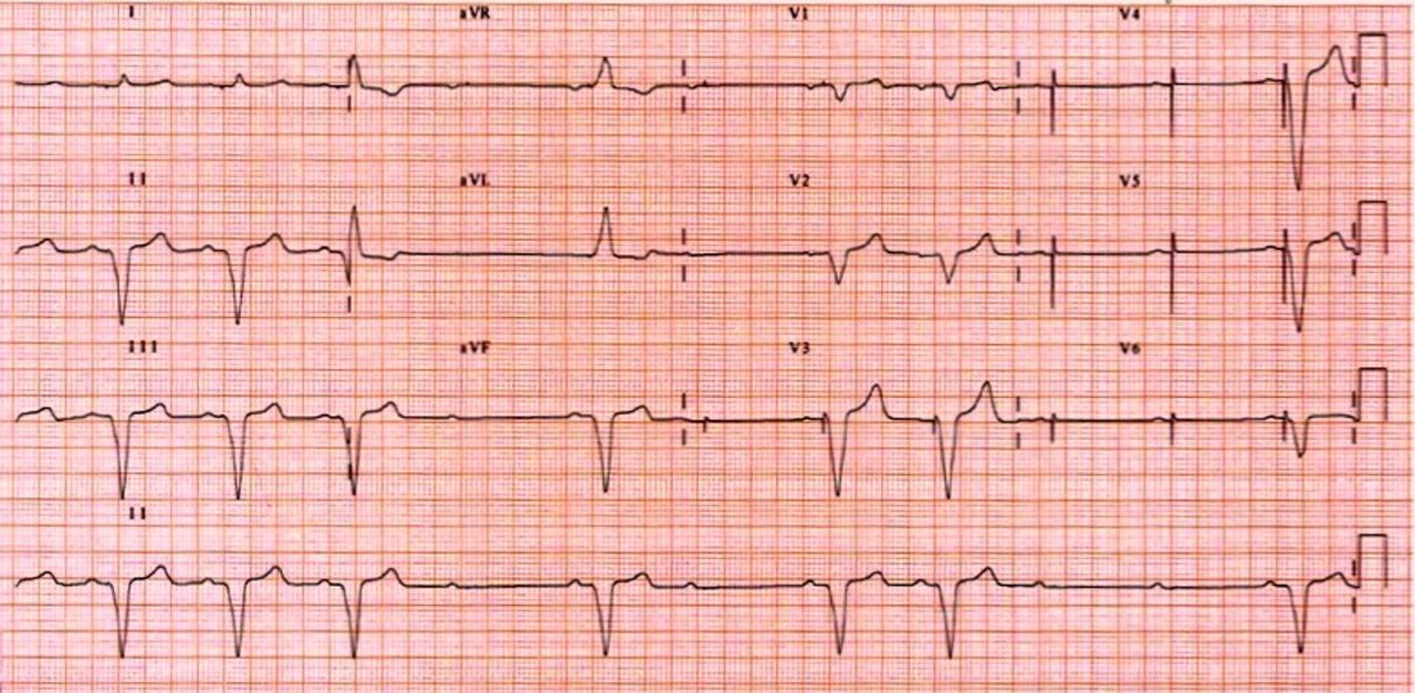 Pacemaker variable Capture