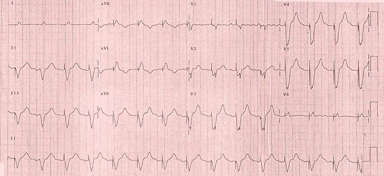 Pacemaker with Capture