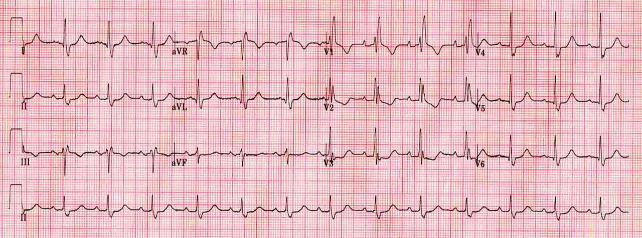 Right Bundle Branch Block