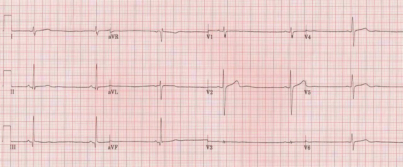 Sinus Bradycardia