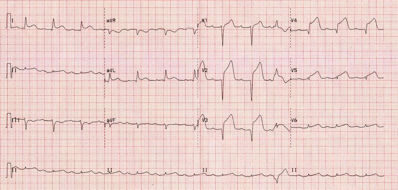 STEMI - Anterior